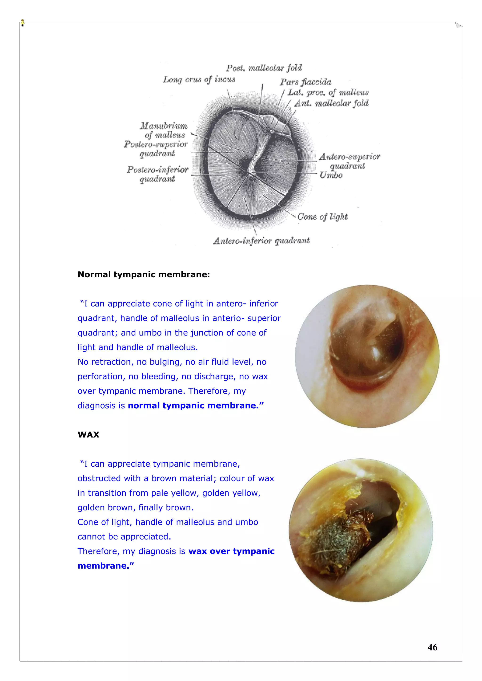 Timpanic Mem Retraction Manikins examination for Medical students | PDF