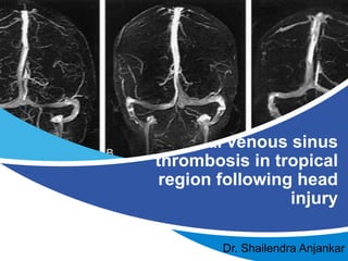 Dural venous sinus
thrombosis in tropical
region following head
injury
Dr. Shailendra Anjankar
 