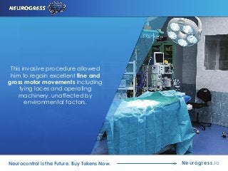 This invasive procedure allowed
him to regain excellent fine and
gross motor movements including
tying laces and operating
machinery, unaffected by
environmental factors.
Neurogress.ioNeurocontrol is the Future. Buy Tokens Now.
 