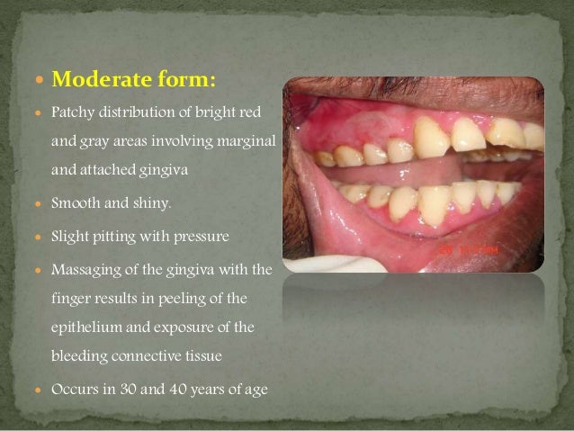 desquamative gingivitis ppt