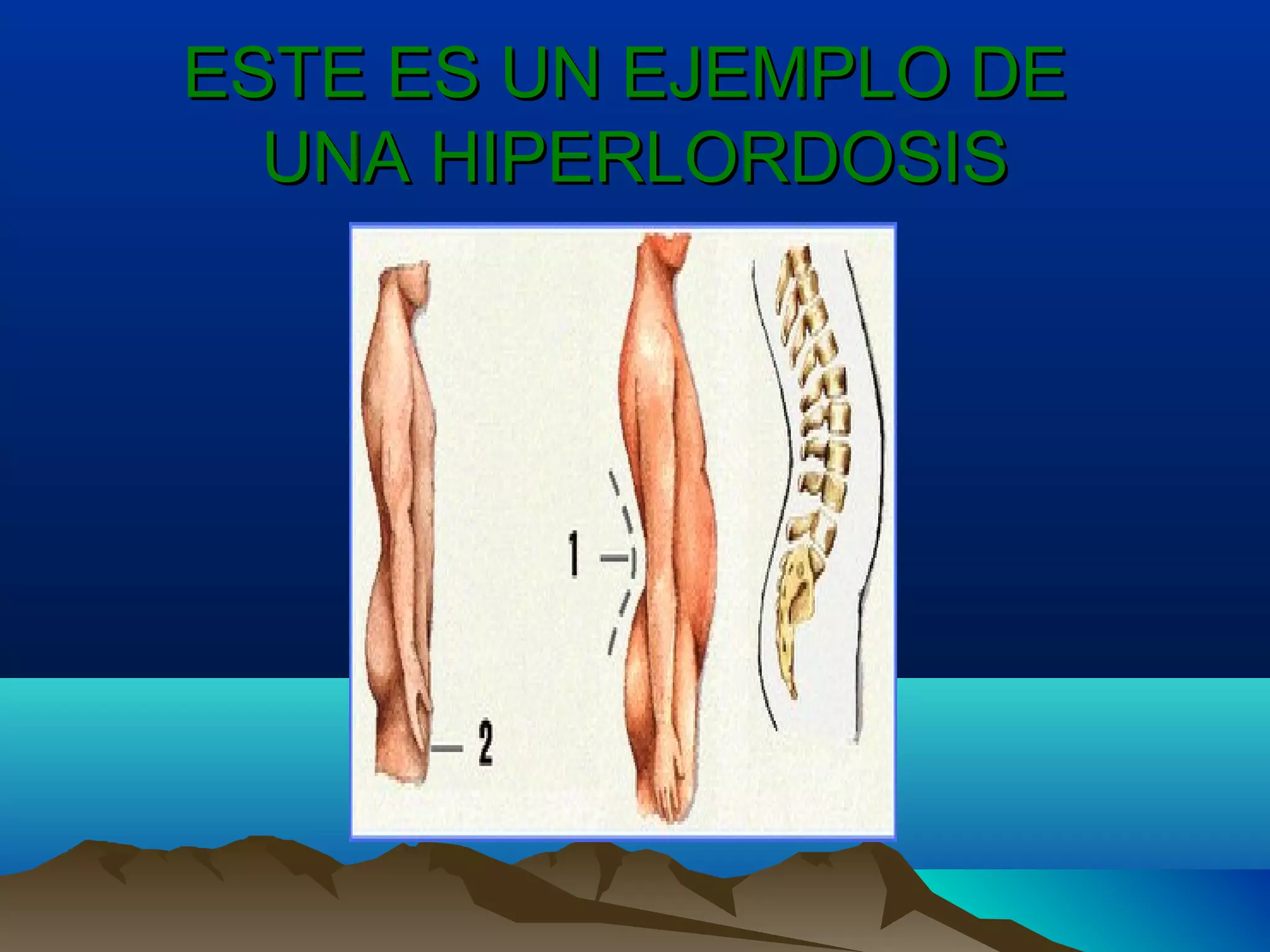 ESTE ES UN EJEMPLO DEESTE ES UN EJEMPLO DE
UNA HIPERLORDOSISUNA HIPERLORDOSIS
 
