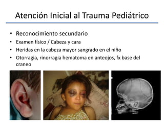 Atención Inicial al Trauma Pediátrico
• Reconocimiento secundario
• Examen físico / Cabeza y cara
• Heridas en la cabeza mayor sangrado en el niño
• Otorragia, rinorragia hematoma en anteojos, fx base del
craneo
 