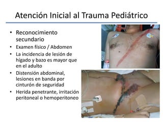 Atención Inicial al Trauma Pediátrico
• Reconocimiento
secundario
• Examen físico / Abdomen
• La incidencia de lesión de
hígado y bazo es mayor que
en el adulto
• Distensión abdominal,
lesiones en banda por
cinturón de seguridad
• Herida penetrante, irritación
peritoneal o hemoperitoneo
 