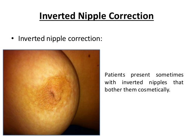 Surgery For Inverted Nipples 13