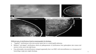 NIPPLE DISCHARGE AND SURGICAL MANAGEMENT | PPTX