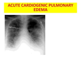 ACUTE CARDIOGENIC PULMONARY
            ACPE
           EDEMA
 