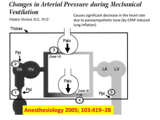 Causes significant decrease in the heart rate
                 due to parasympathetic tone (by CPAP induced
                 lung inflation)




Anesthesiology 2005; 103:419–28
 