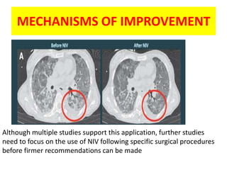 MECHANISMS OF IMPROVEMENT




Although multiple studies support this application, further studies
need to focus on the use of NIV following specific surgical procedures
before firmer recommendations can be made
 