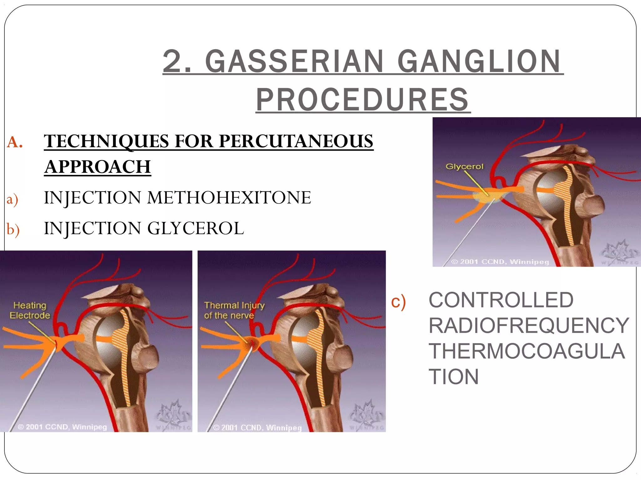 2. GASSERIAN GANGLION
PROCEDURES
A. TECHNIQUES FOR PERCUTANEOUS
APPROACH
a) INJECTION METHOHEXITONE
b) INJECTION GLYCEROL
c) CONTROLLED
RADIOFREQUENCY
THERMOCOAGULA
TION
 