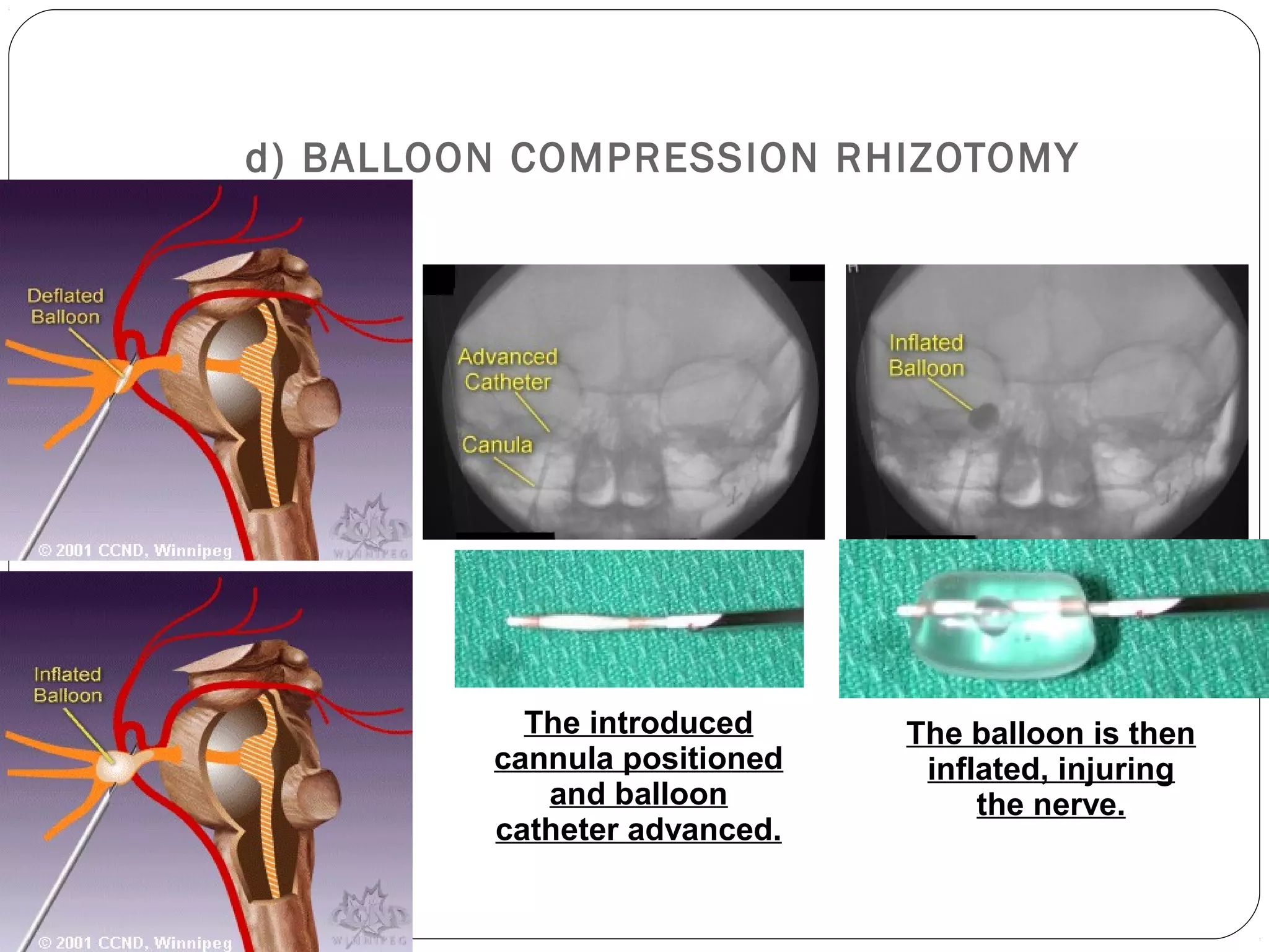 d) BALLOON COMPRESSION RHIZOTOMY
The introduced
cannula positioned
and balloon
catheter advanced.
The balloon is then
inflated, injuring
the nerve.
 
