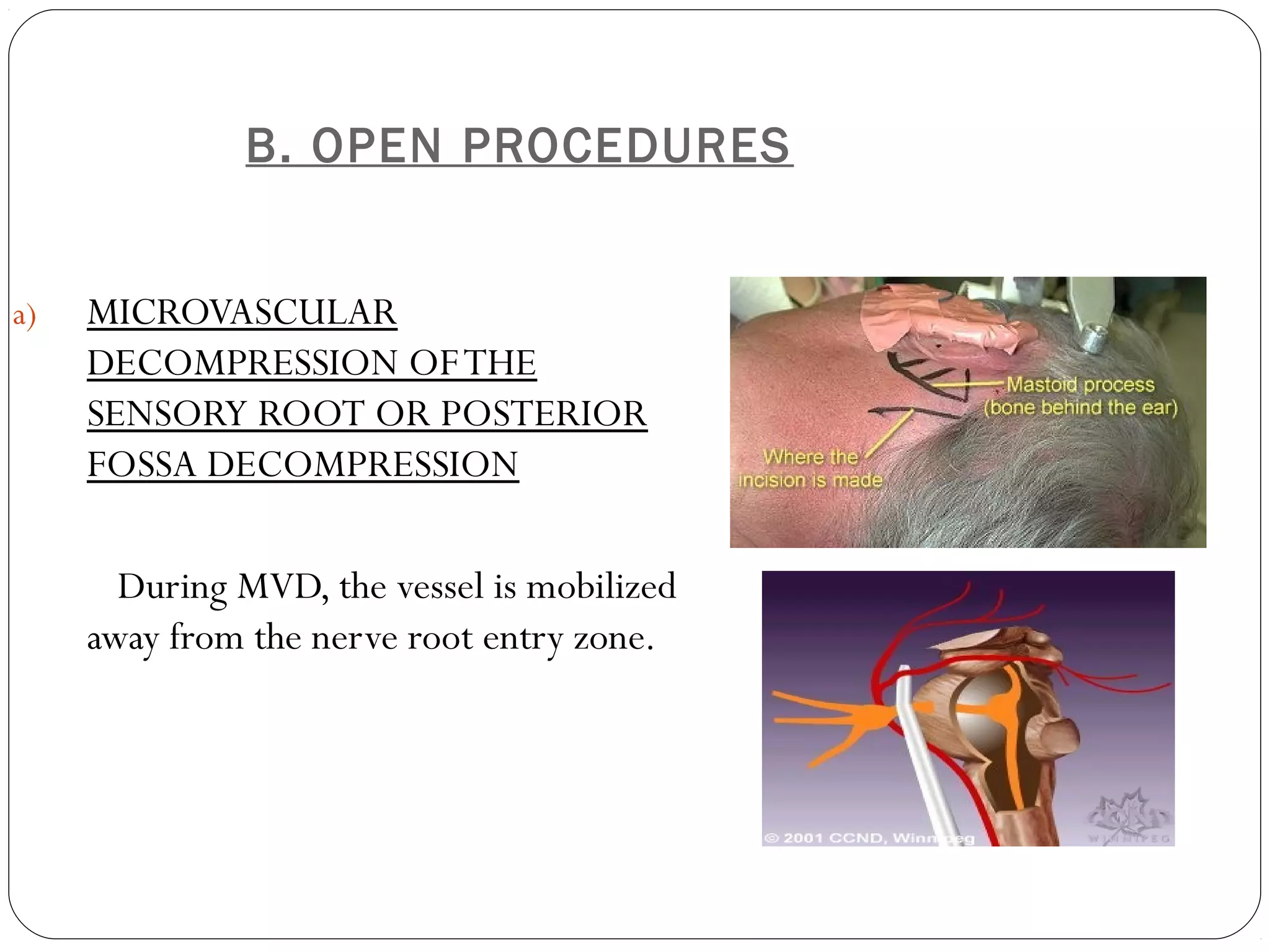 B. OPEN PROCEDURES
a) MICROVASCULAR
DECOMPRESSION OFTHE
SENSORY ROOT OR POSTERIOR
FOSSA DECOMPRESSION
During MVD, the vessel is mobilized
away from the nerve root entry zone.
 