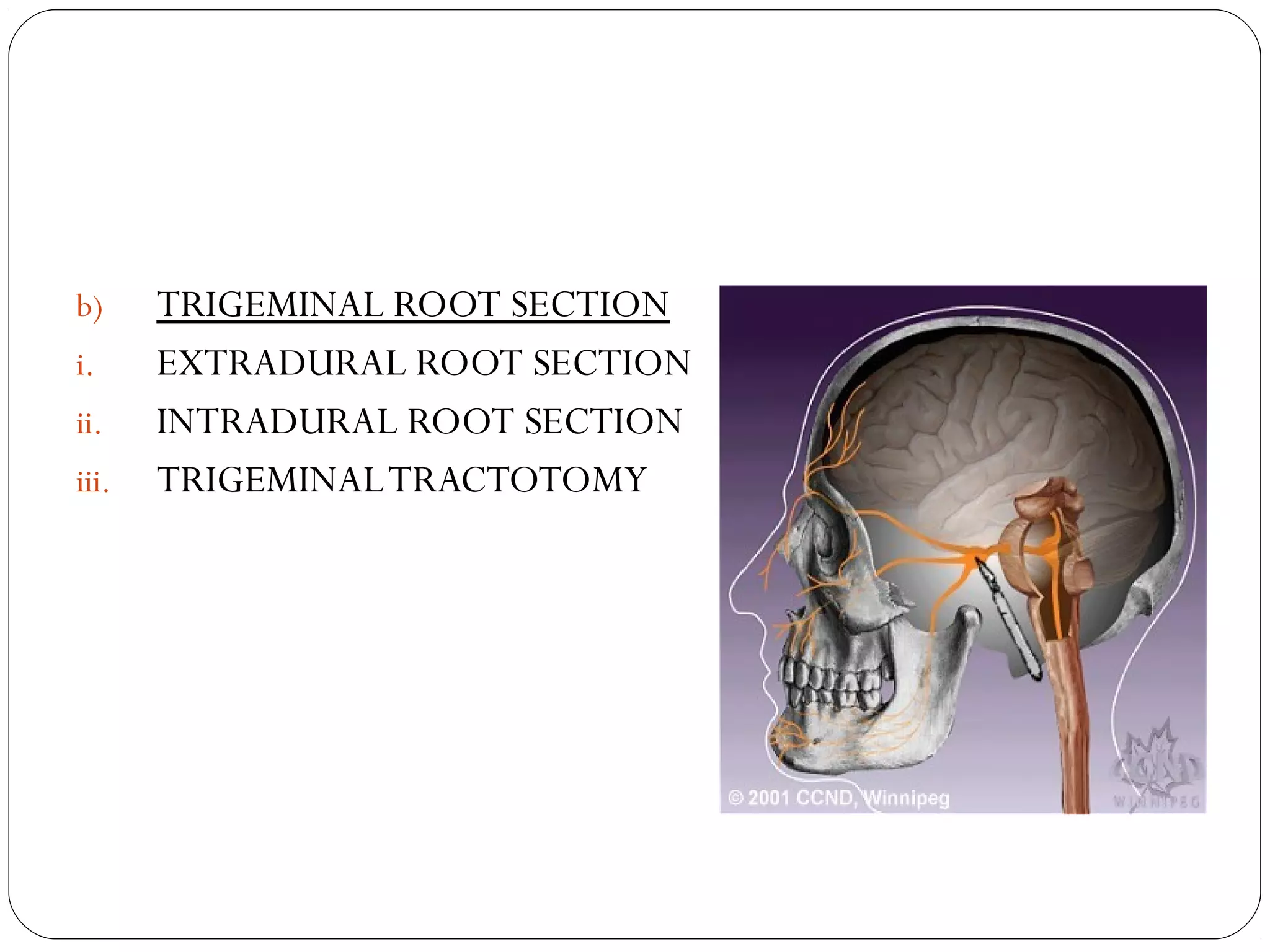 b) TRIGEMINAL ROOT SECTION
i. EXTRADURAL ROOT SECTION
ii. INTRADURAL ROOT SECTION
iii. TRIGEMINALTRACTOTOMY
 