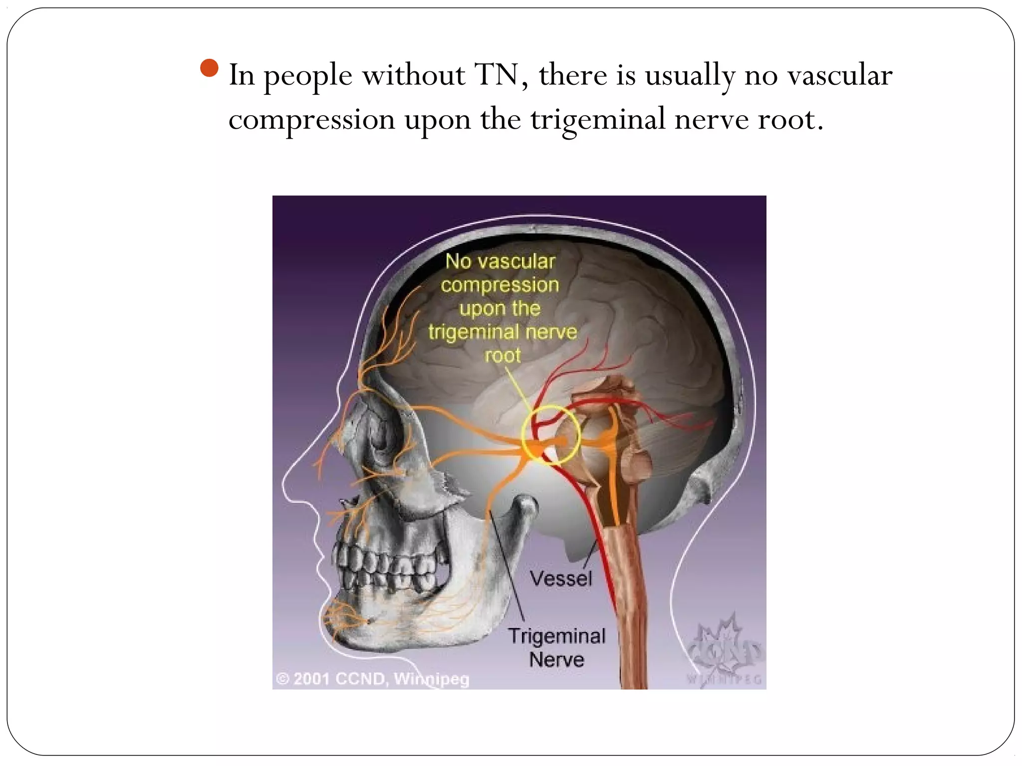 In people without TN, there is usually no vascular
compression upon the trigeminal nerve root.
 