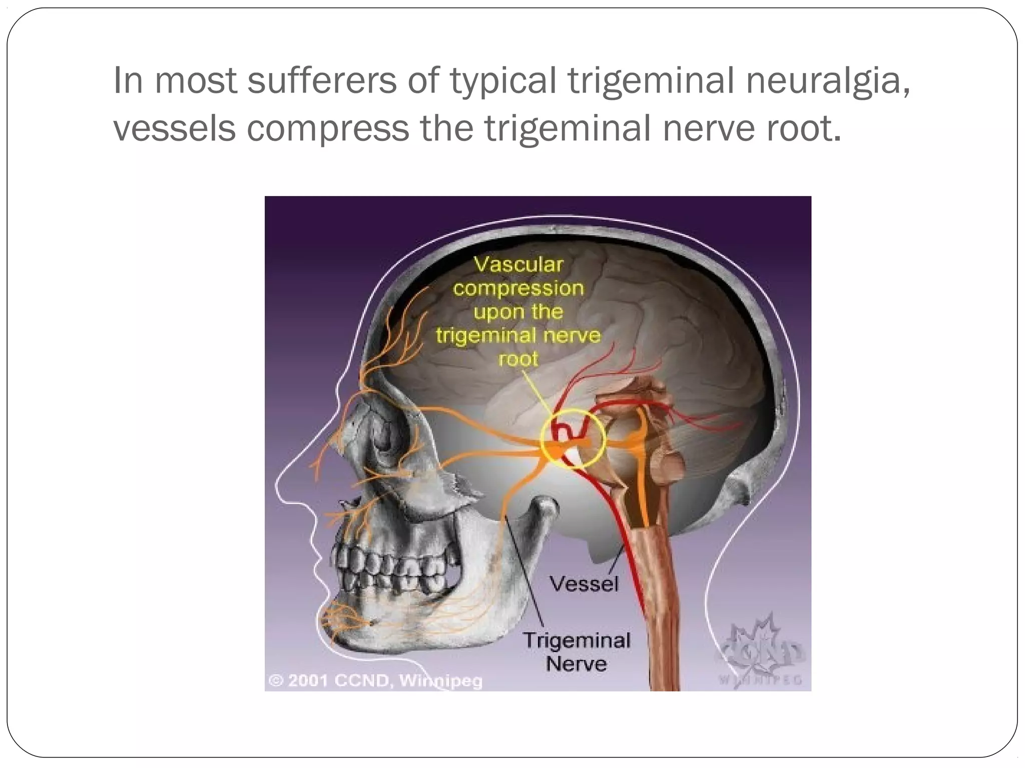 In most sufferers of typical trigeminal neuralgia,
vessels compress the trigeminal nerve root.
 