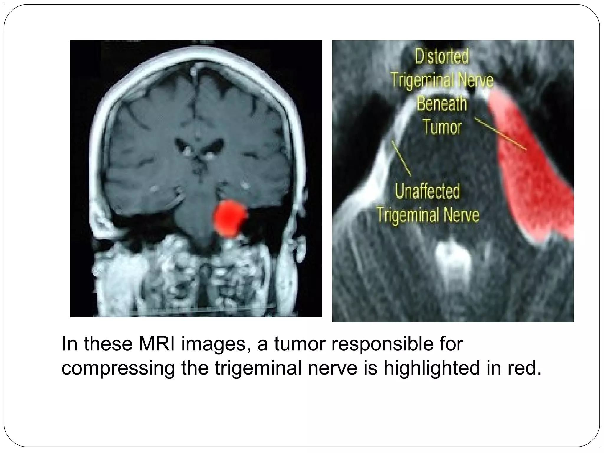 In these MRI images, a tumor responsible for
compressing the trigeminal nerve is highlighted in red.
 