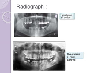 Radiograph :
Hyperplasia
of right
condyle
 