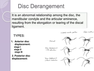 Disc Derangement
It is an abnormal relationship among the disc, the
mandibular condyle and the articular eminence,
resulting from the elongation or tearing of the discal
ligament.
TYPES:
1. Anterior disc
displacement:
stage I
stage II
stage III
2. Posterior disc
displacement:
 