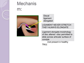 Mechanis
m:
Discal
ligament
elongated
LIGAMENT NEVER STRETCH
THEY ALWAYS ELONGATE
Ligament elongate-morphology
of disc altered –disc permitted to
slide across articular surface of
condyle
(not present in healthy
TMJ)
 