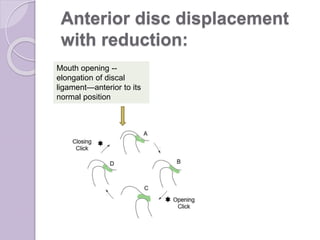 Anterior disc displacement
with reduction:
Mouth opening --
elongation of discal
ligament—anterior to its
normal position
 