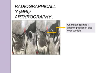 RADIOGRAPHICALL
Y (MRI)/
ARTHROGRAPHY :
On mouth opening :
anterior position of disc
over condyle
 