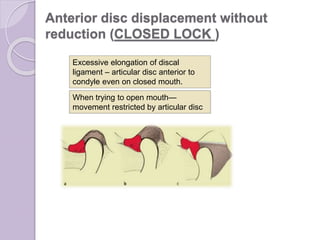 Anterior disc displacement without
reduction (CLOSED LOCK )
Excessive elongation of discal
ligament – articular disc anterior to
condyle even on closed mouth.
When trying to open mouth—
movement restricted by articular disc
 