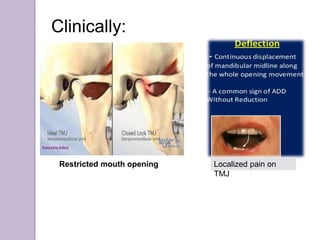 Localized pain on
TMJ
Restricted mouth opening
Clinically:
 