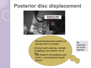 Posterior disc displacement
Abnormal backward position of
articular disc to condyle.
During mouth opening, condyle
is slipping over anterior rim of
disc.
Disc folded in the posterior part
of joint , preventing full mouth
closure
No
restriction
on mouth
opening
 
