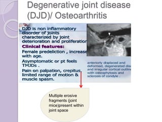 Degenerative joint disease
(DJD)/ Osteoarthritis
Multiple erosive
fragments (joint
mice)present within
joint space
 