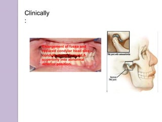 Enlargement of fossa and
reduced condylar head size –
condyle moves forward &
superiorly into abnormal
anterior position.
Clinically
:
 