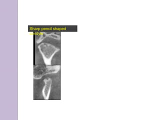 Sharp pencil shaped
condyle
 
