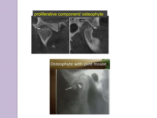 proliferative component/ osteophyte
 