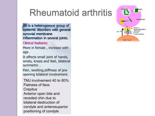 Rheumatoid arthritis
TMJ involvement 40 to 80%
Flatness of face.
Crepitus
Anterior open bite and
receded chin due to
bilateral destruction of
condyle and anterosuperior
positioning of condyle
 