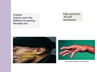 Flatness of face
on affected TMJ
area
Felty syndrome:
RA with
neutropenia
Crepitus
Anterior open bite
Stiffness on opening
Receded chin
 