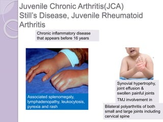 Juvenile Chronic Arthritis(JCA)
Still’s Disease, Juvenile Rheumatoid
Arthritis
Synovial hypertrophy,
joint effusion &
swollen painful joints
Associated splenomegaly,
lymphadenopathy, leukocytosis,
pyrexia and rash
TMJ involvement in
40%
Chronic inflammatory disease
that appears before 16 years
Bilateral polyarthritis of both
small and large joints including
cervical spine
 
