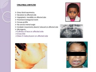 Fullness of face on affected side
Cross bite
Class II malocclusion on affected side
 