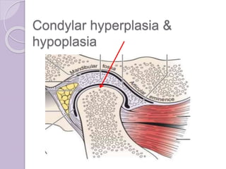 Condylar hyperplasia &
hypoplasia
 