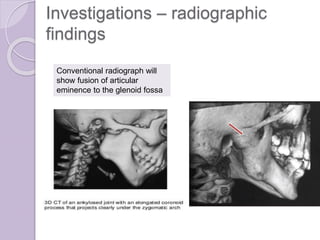 Investigations – radiographic
findings
Conventional radiograph will
show fusion of articular
eminence to the glenoid fossa
 