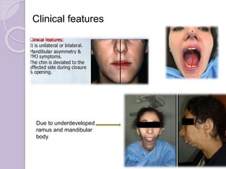 Clinical features
Due to underdeveloped
ramus and mandibular
body
 