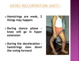  Hamstrings are weak, 2
things may happen
 During stance phase –
knee will go in hyper
extension
 During the deceleration –
hamstrings slow down
the swing forward
 