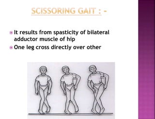  It results from spasticity of bilateral
adductor muscle of hip
 One leg cross directly over other
 