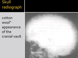 Skull radiographcotton wool" appearance of the cranial vault