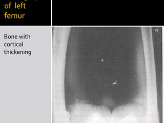 Radiograph of  left femurBone with cortical thickening