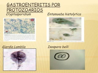 GASTROENTERITIS POR
PROTOZOARIOS
Cryptosporidium Entamoeba histolytica
Giardia Lamblia Isospora belli
 