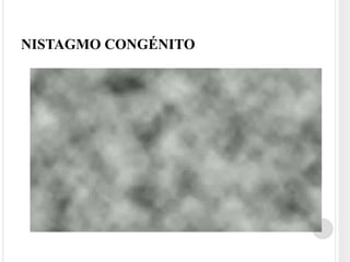 NISTAGMO CONGÉNITO
 