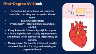 Definition: All atrial impulses reach the
ventricles, but they are delayed at the AV
node.
ECG Characteristics:
Prolonged PR interval (>0.20 seconds in
adults).
Every P wave is followed by a QRS complex.
Clinical Significance: Usually asymptomatic
and benign. Often discovered incidentally on
an ECG.
Management: No specific treatment usually
required. Monitor for progression to higher
degrees of block.
First-Degree AV Block
 