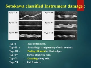 Sotokawa classified Instrument damage : 
Type I : Bent instrument. 
Type II : Stretching / straightening of twist contour. 
Type III : Peeling off metal at blade edges. 
Type IV : Partial clockwise turn. 
Type V : Cracking along axis. 
Type VI : Full fracture. 
 