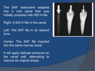 The SAF instrument adapted
into a root canal that was
initially prepared with #20 K-file.
Right: A #20 K-file in the canal.
Left: The SAF file in its relaxed
form.
Center: The SAF file inserted
into the same narrow canal.
It will apply delicate pressure on
the canal wall, attempting to
resume its original shape.
 
