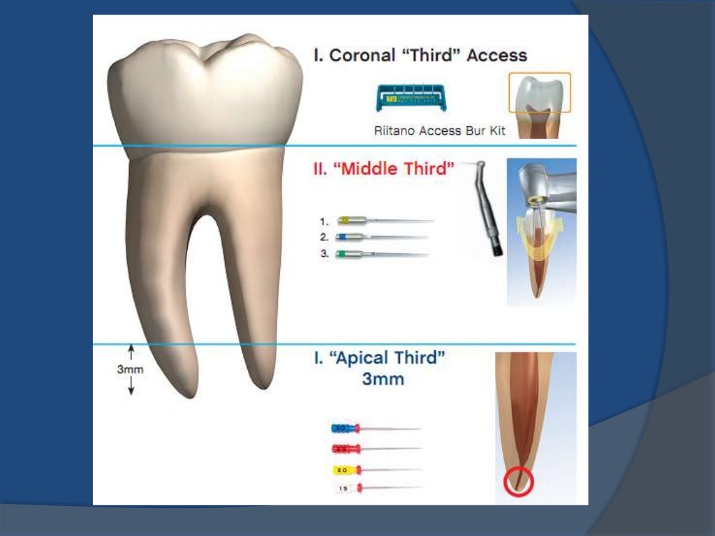 Nickel Titanium Instruments in Endodontics