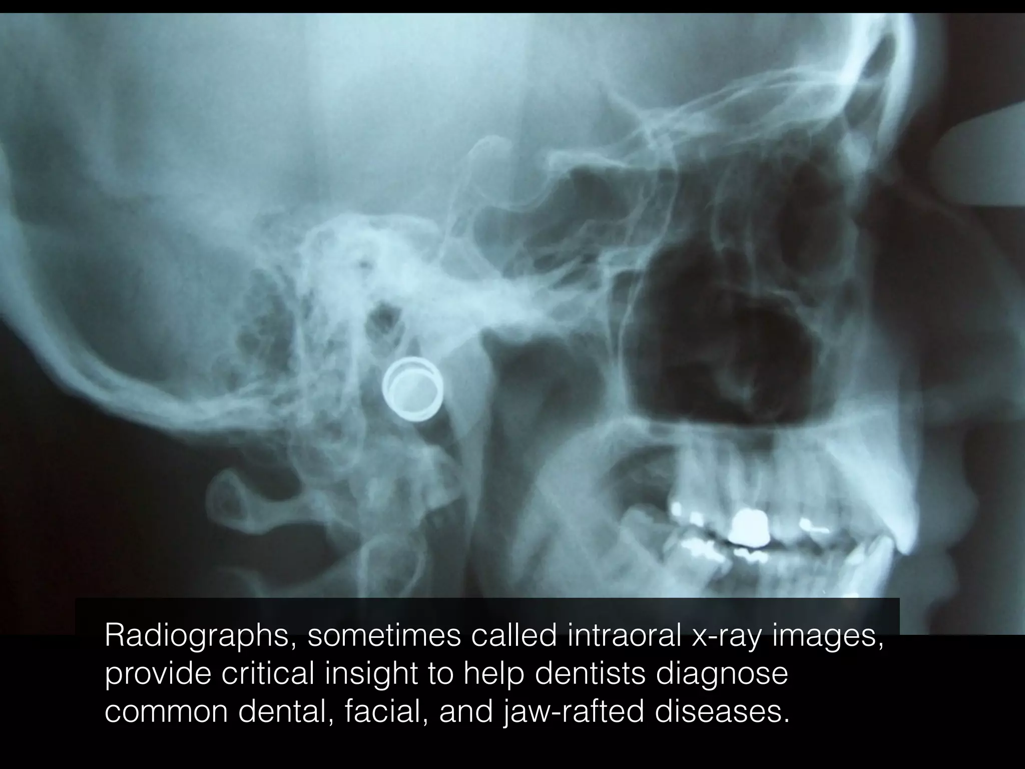 Radiographs, sometimes called intraoral x-ray images,
provide critical insight to help dentists diagnose
common dental, facial, and jaw-rafted diseases.