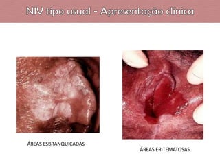 ÁREAS ESBRANQUIÇADAS
ÁREAS ERITEMATOSAS

 